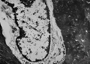 M,19y. | osteocyte - chondrosarcoma - jaw M,19y. | osteocyte - chondrosarcoma - jaw